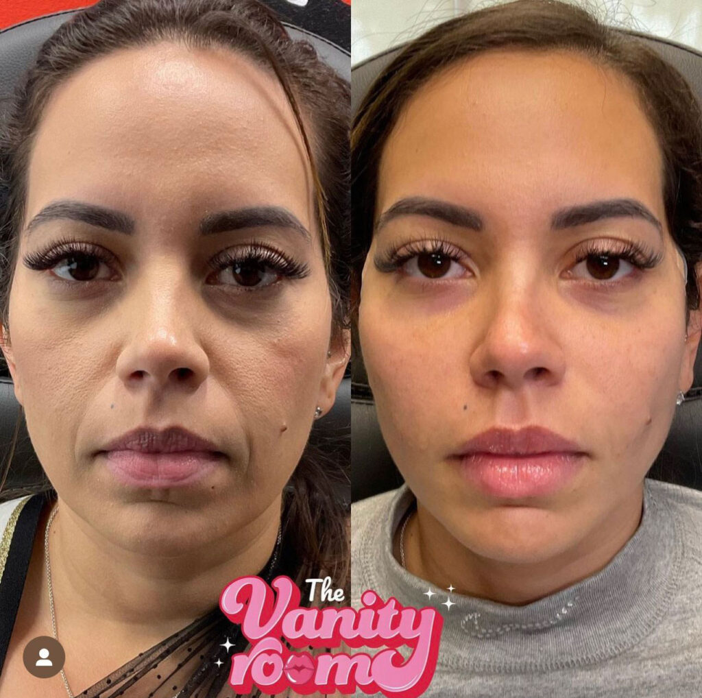 Another example of successful dermal fillers at The Vanity Room. After treatment, the client's face has fewer wrinkles and restored volume in their face.