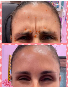 A client with deep wrinkles on their forehead in the before picture. After a Botox treatment, there forehead is smooth and wrinkle-free!