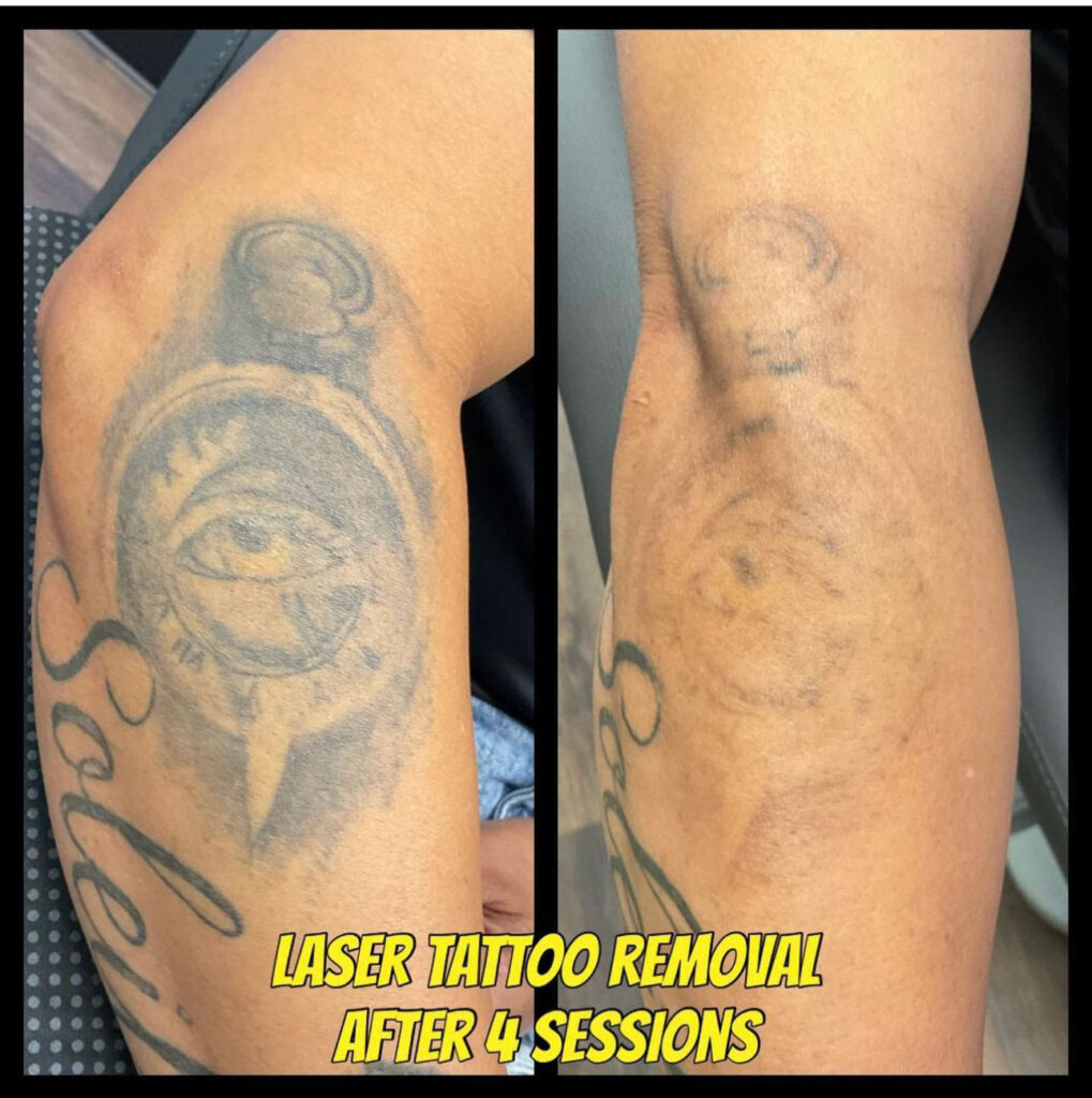 A client with a tattoo on their forearm before and after 4 sessions of laser tattoo removal. The results are amazing!