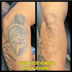 A client with a tattoo on their forearm before and after 4 sessions of laser tattoo removal. The results are amazing!