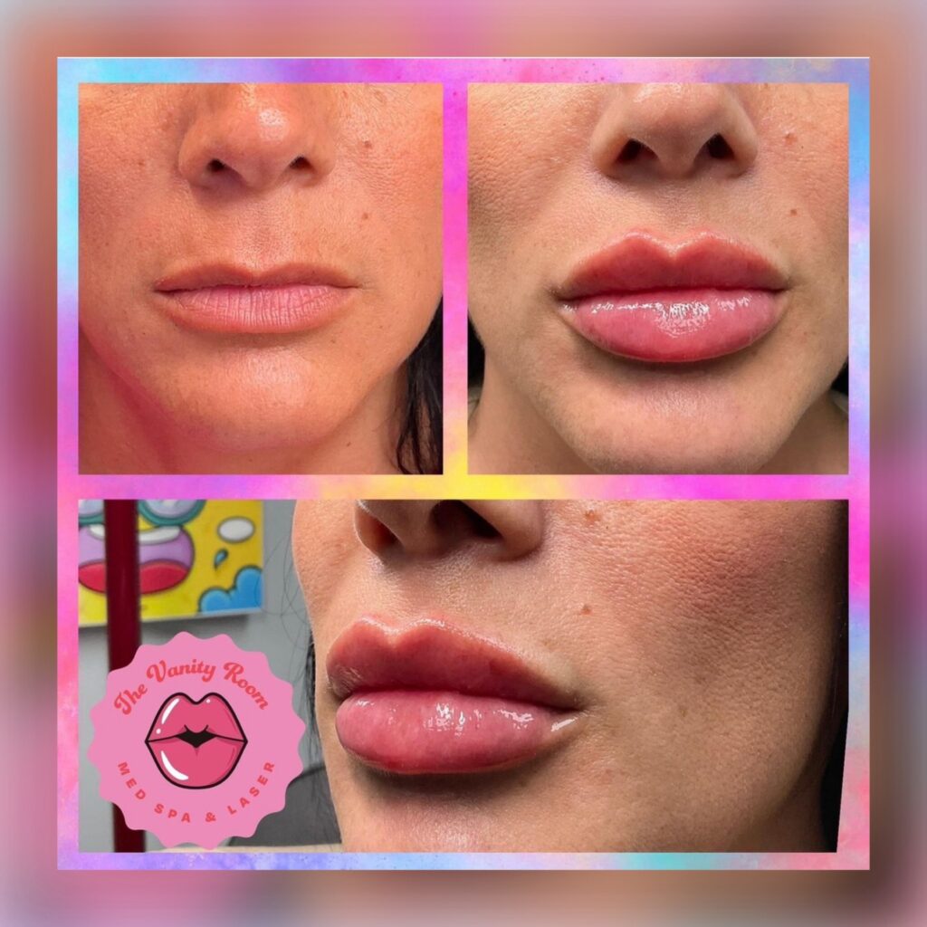 A before and after image of a client who got lip fillers at The Vanity Room. Their lips are much fuller afterwards.