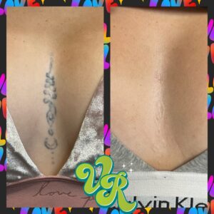 A tattoo on a client's chest before and after it is removed via laser tattoo removal