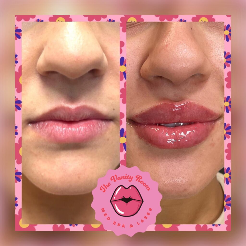 a client who received lip fillers at The Vanity Room and had excellent results