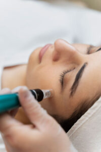 A client receiving a microneedling treatment at The Vanity Room